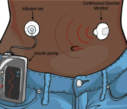Insulin pumps for diabetes