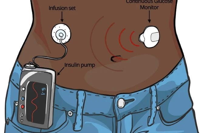Insulin pumps for diabetes