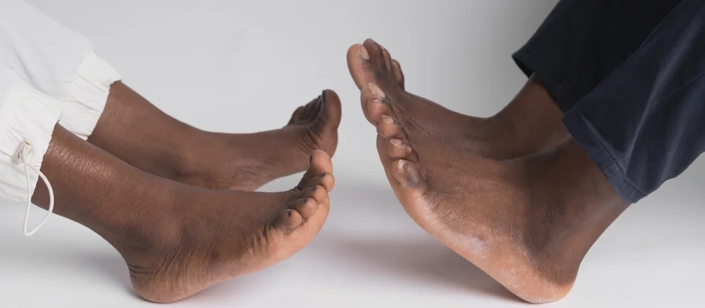 Diabetes and foot problems